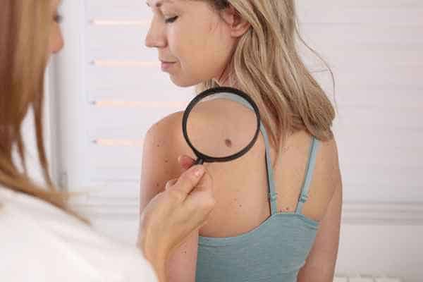 What Are Traditional Skin Lesion Removal Methods Kings Langley?