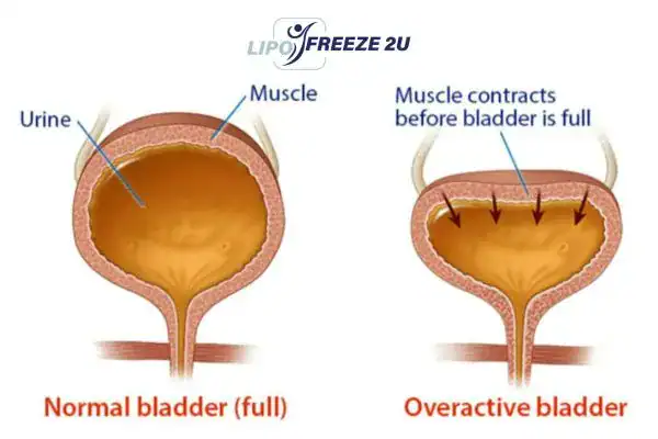 diagram of overactive bladder treatment Kings Langley