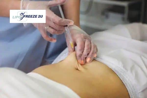 How Does Aqualyx Fat Dissolving Injection Work to Break Down Fat Kings Langley?