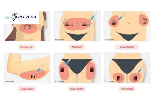 Benefits of Choosing Aqualyx for Fat Reduction Kings Langley