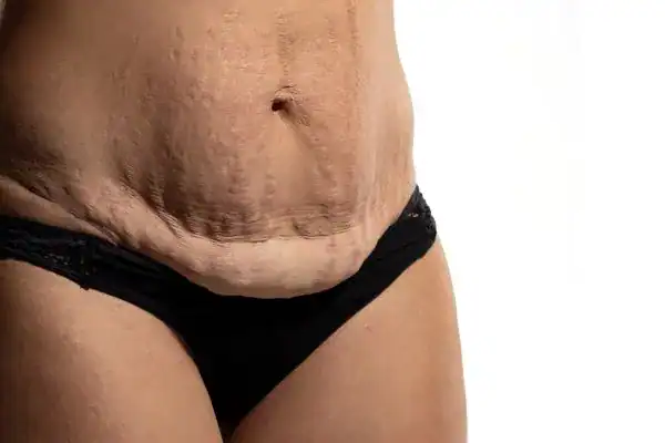 loose skin after weight loss injections Kings Langley