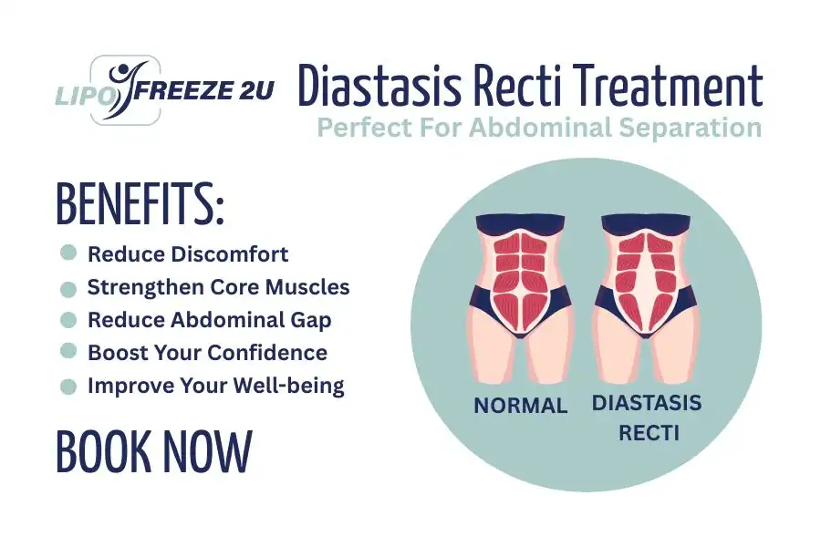 How Long Will It Take to See Improvements in Diastasis Recti Kings Langley