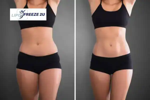 How Can LIPO FREEZE 2U Support Your Post-Pregnancy Body Recovery Kings Langley?