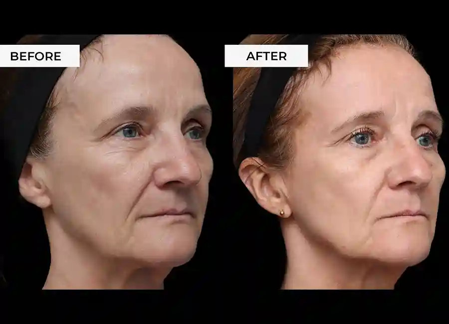 How Many RF Microneedling Sessions Will You Need to See a Difference Kings Langley?