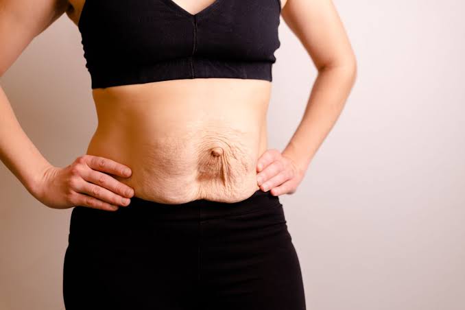 Is Surgery Really the Only Way to Repair Diastasis Recti Kings Langley?