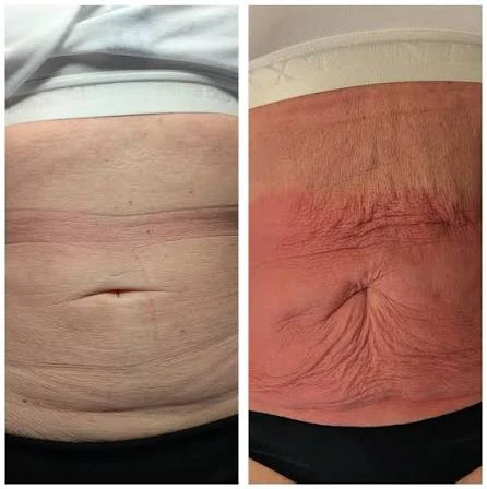 How Does RF Microneedling Improve Crepey, Thin and Uneven Skin Texture Kings Langley?