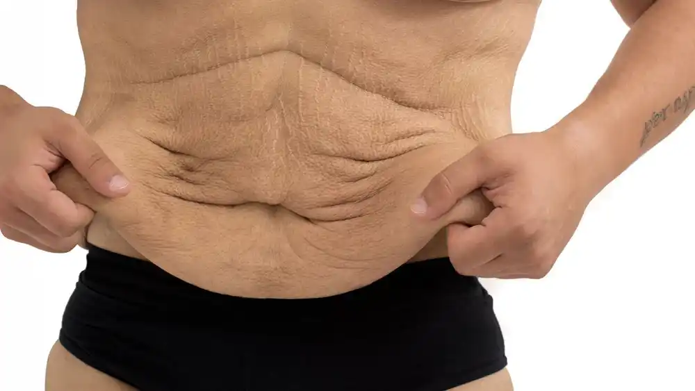 RF Microneedling for Loose Skin: How Can It Help Tighten and Reshape the Skin Kings Langley?
